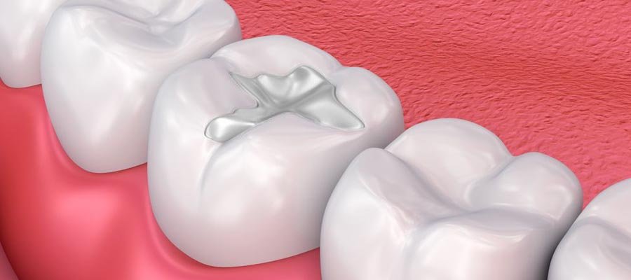 Tooth-Colored Dental Composite Fillings